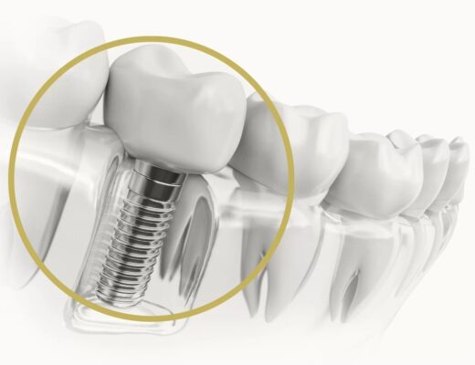 What Makes Dental Implants Better Than Other Options?