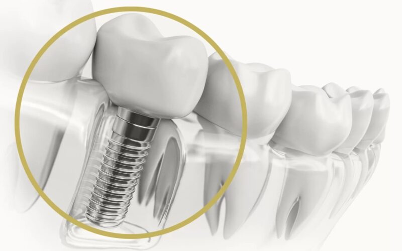 What Makes Dental Implants Better Than Other Options?